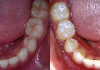 窩溝封閉、涂氟防蛀